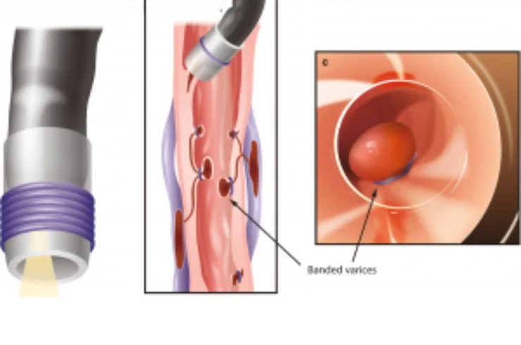 Variceal Banding