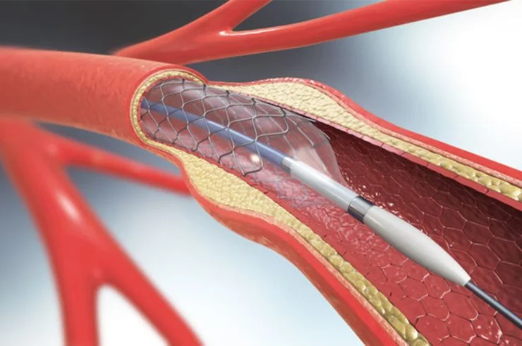 Stenting