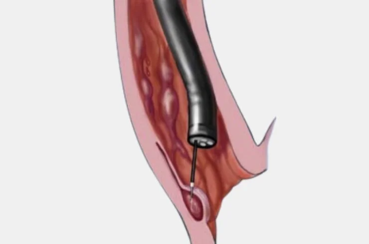 Injection Sclerotherapy----4 (2)